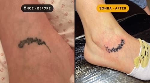 Cover-up & Scar-up — Black Ink Art